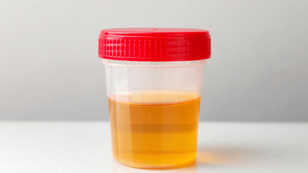 Urinprobe in transparentem Becher mit rotem Deckel