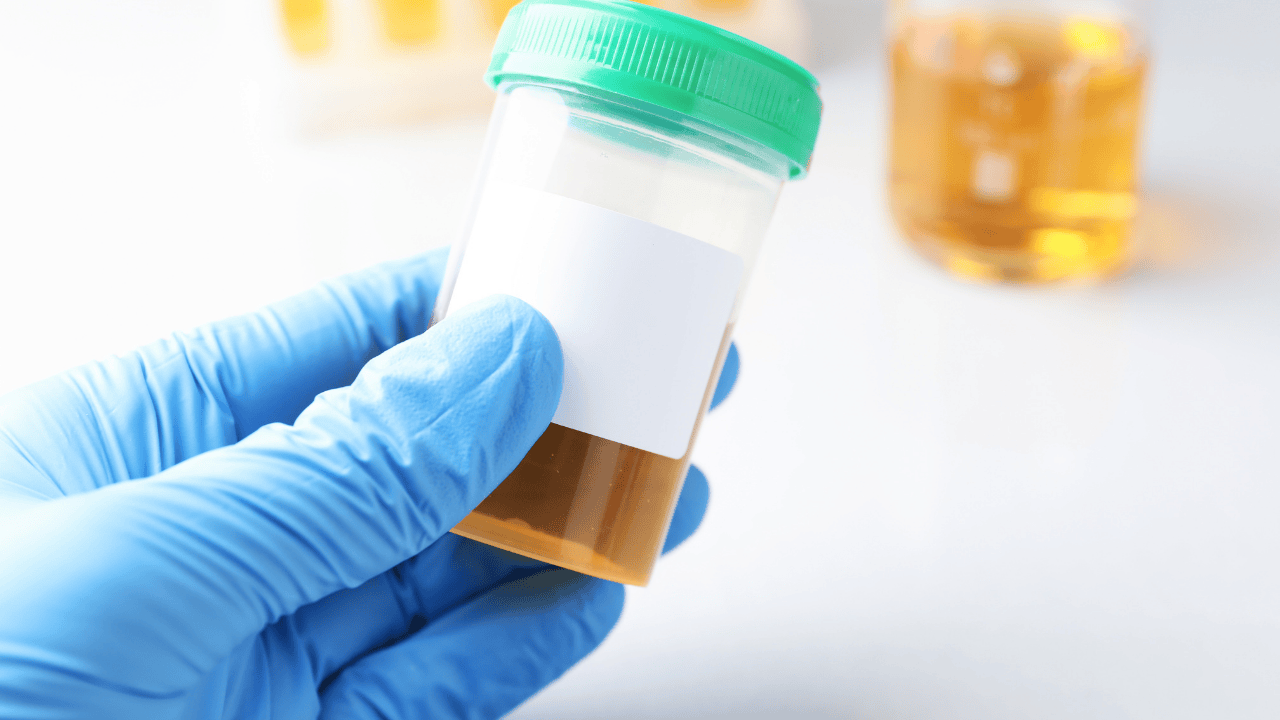 Hand mit blauem Handschuh hält Urinprobe im Kunststoffbecher